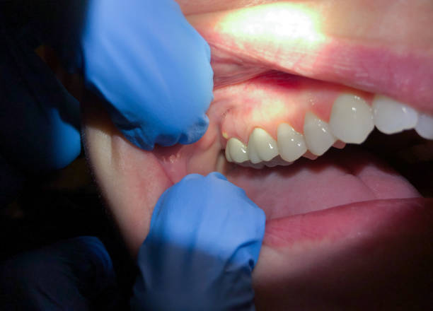 Best Emergency Dental Extractions in Berne, IN